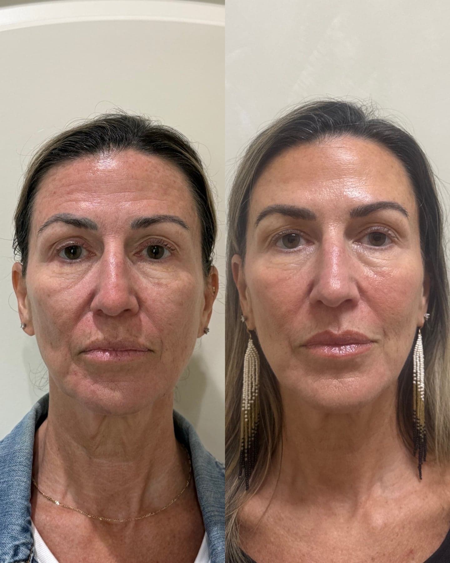 Botox before & after 1