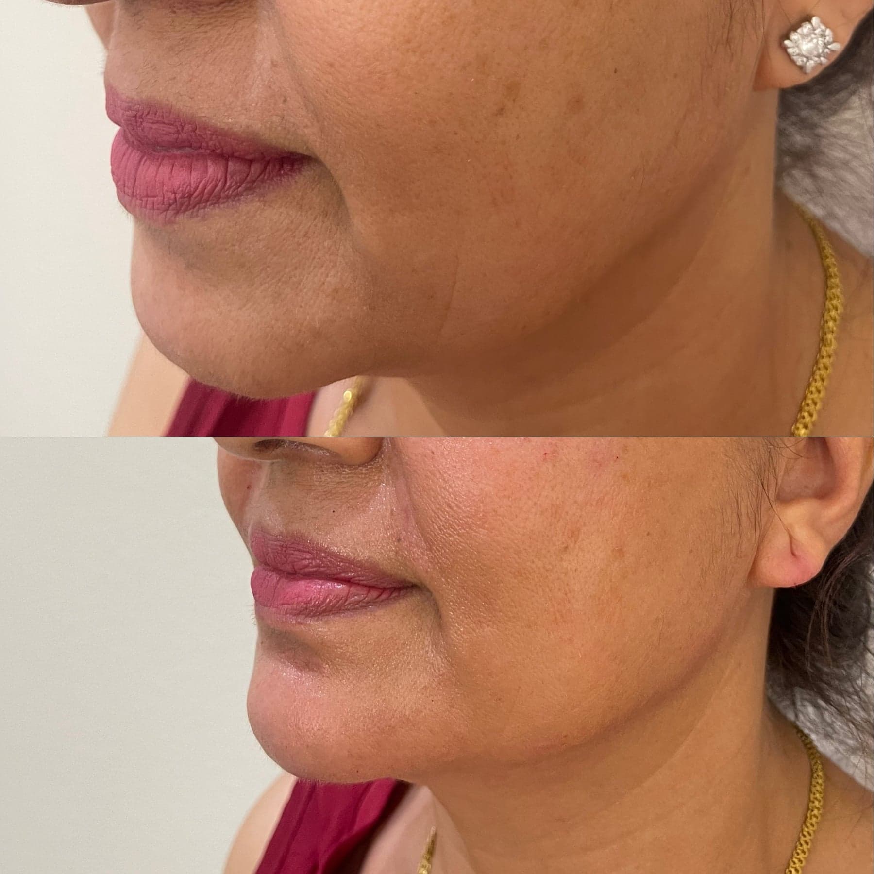 Dermal filler before & after 1