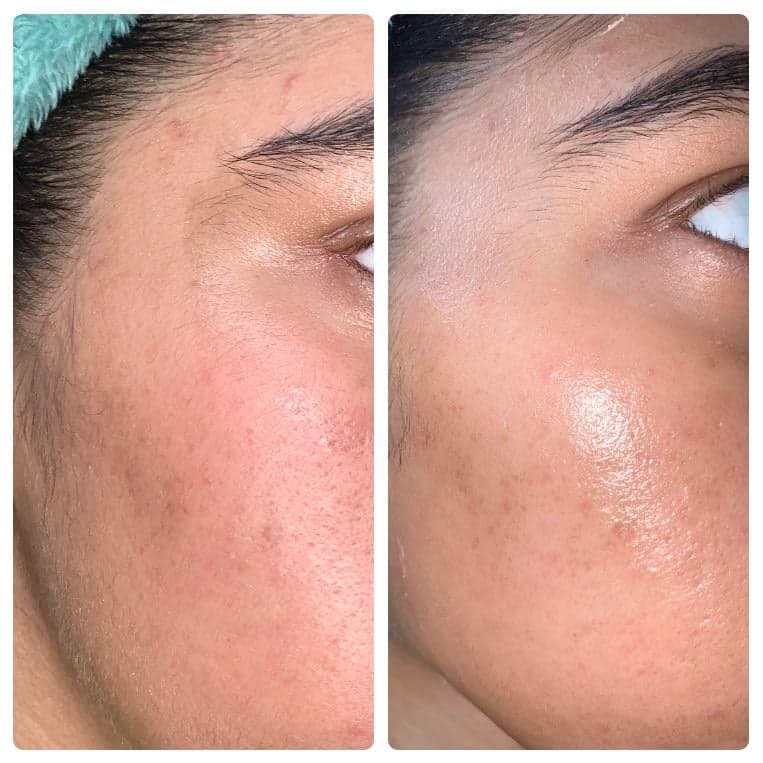 Dermaplane before & after 1