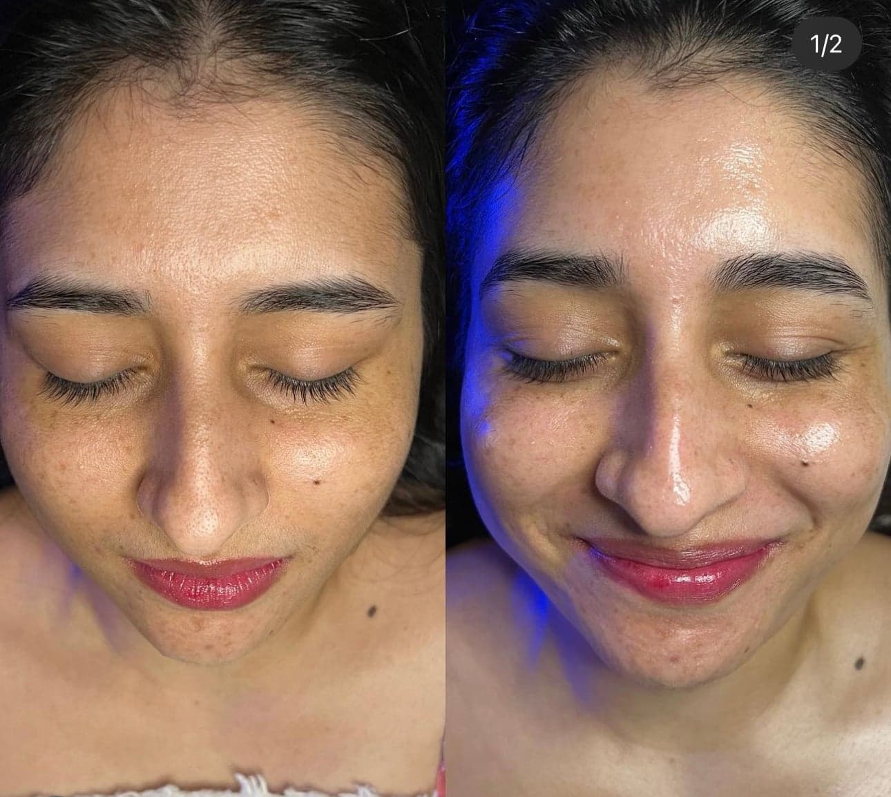 HydraFacial before & after 1
