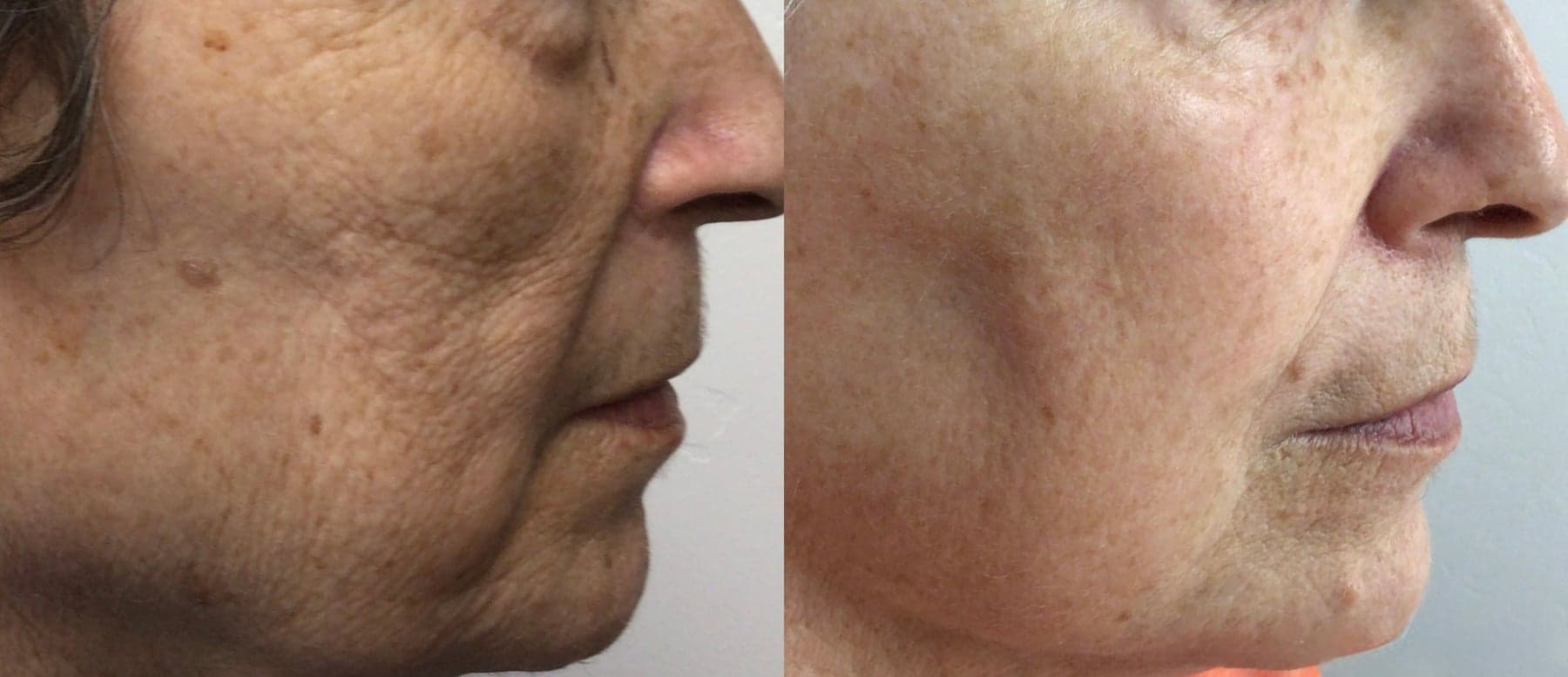 IPL photofacial before & after 1