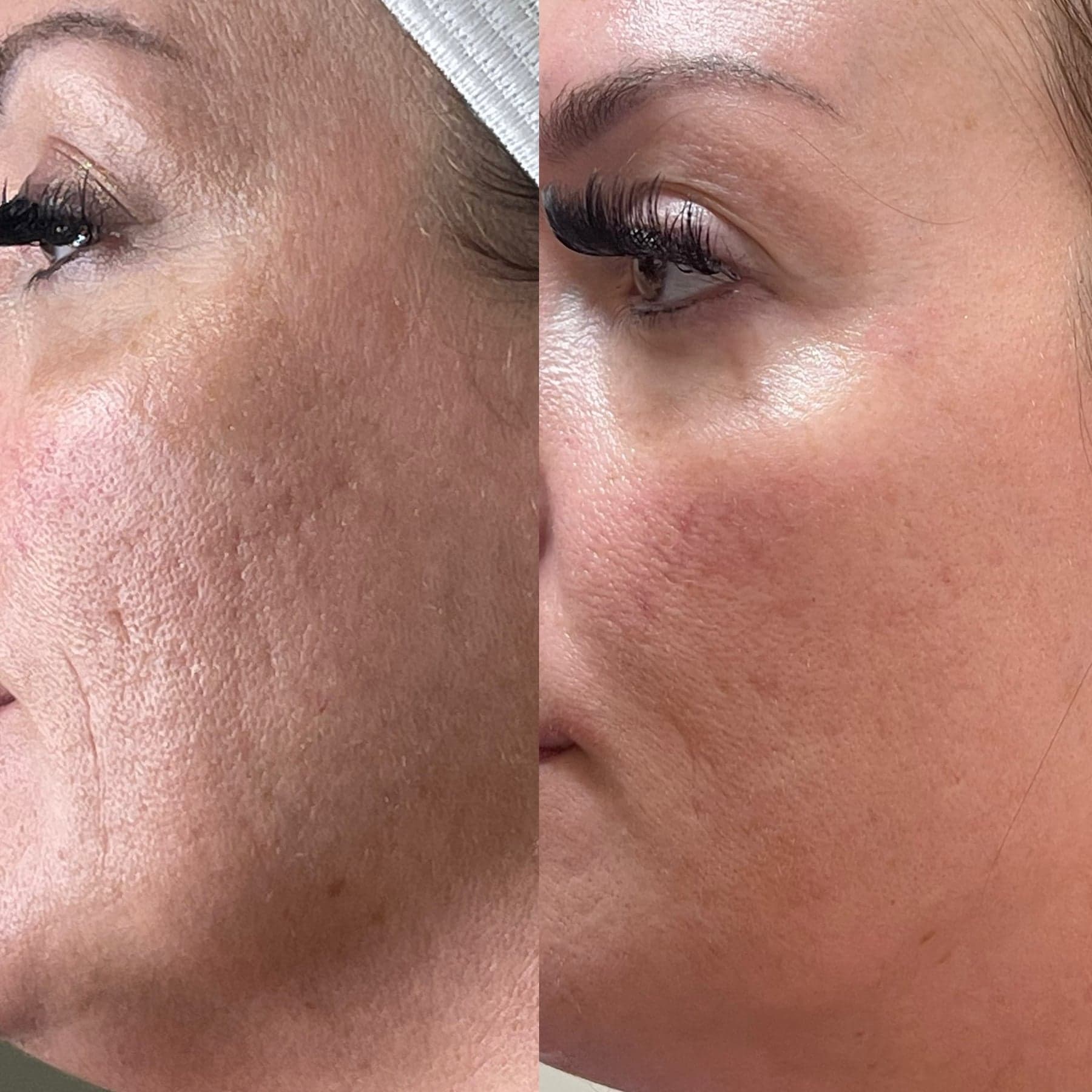 Microneedling before & after 1
