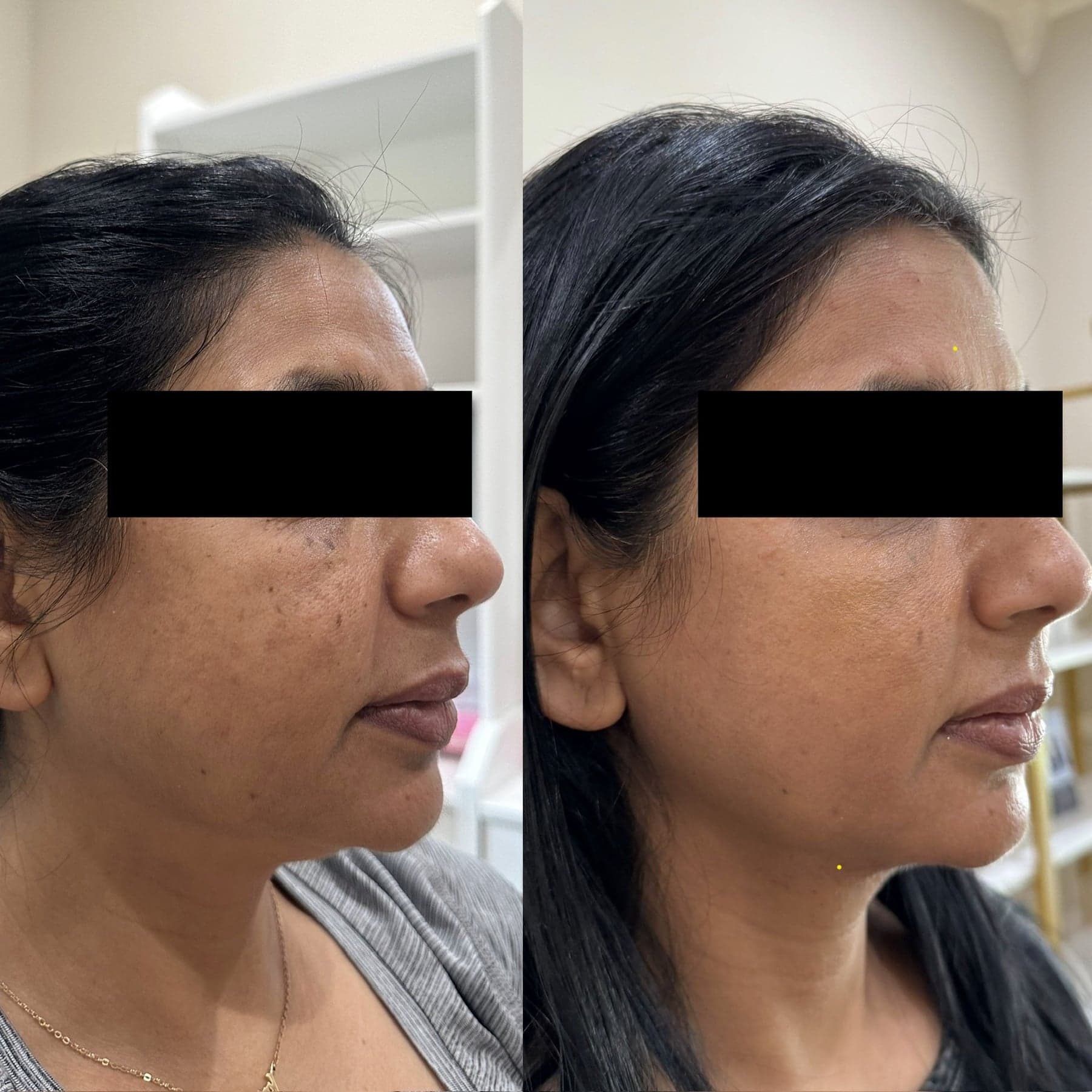 Morpheus8 before & after 1