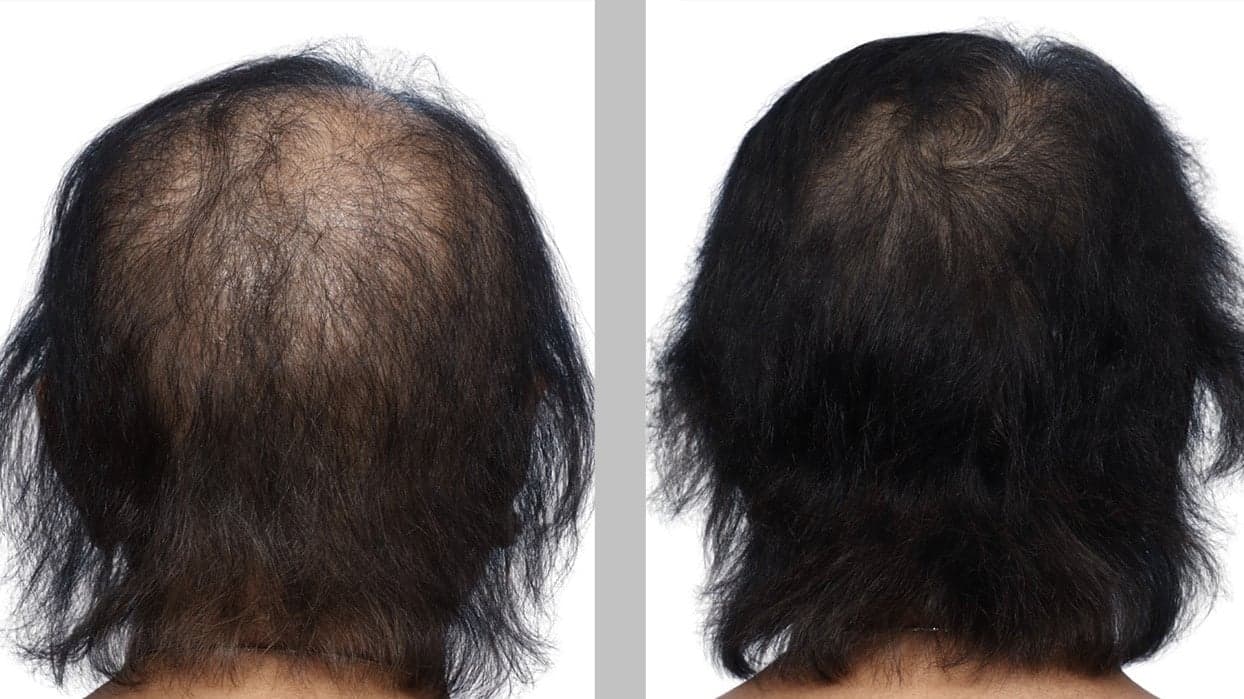 PRP hair restoration before & after 1